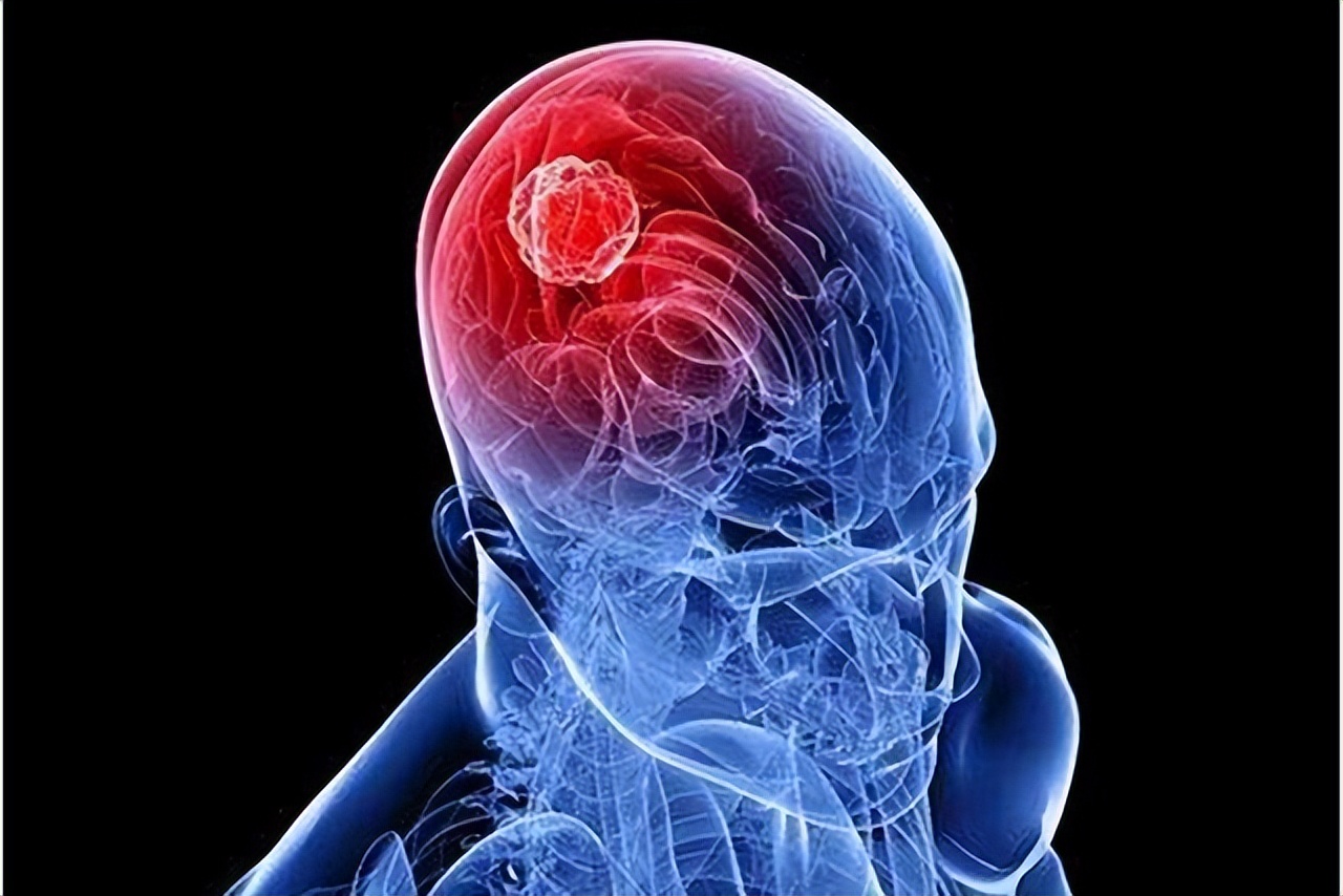 恶性肿瘤患者放疗期间吃点什么好,恶性肿瘤放疗后的注意事项