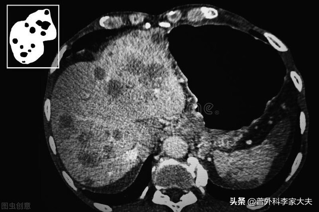 肝癌晚期可以带瘤生存吗,肝癌晚期出现黑便还能生存多久