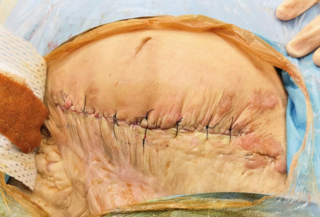 被车碾压的女孩救活了么,被大货车碾过的人