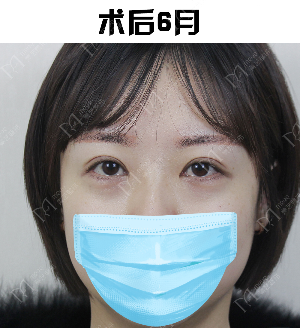 我做了双眼皮下眼睑会肿怎么回事,做了双眼皮十天肉条感严重怎么办