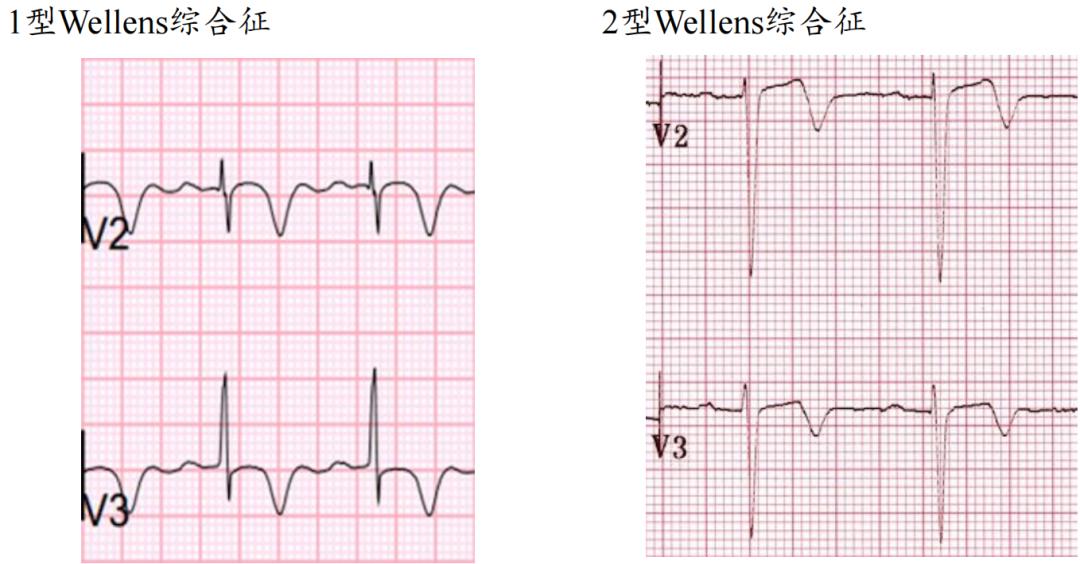 t波倒置三种常见原因,t波低平倒置有事吗