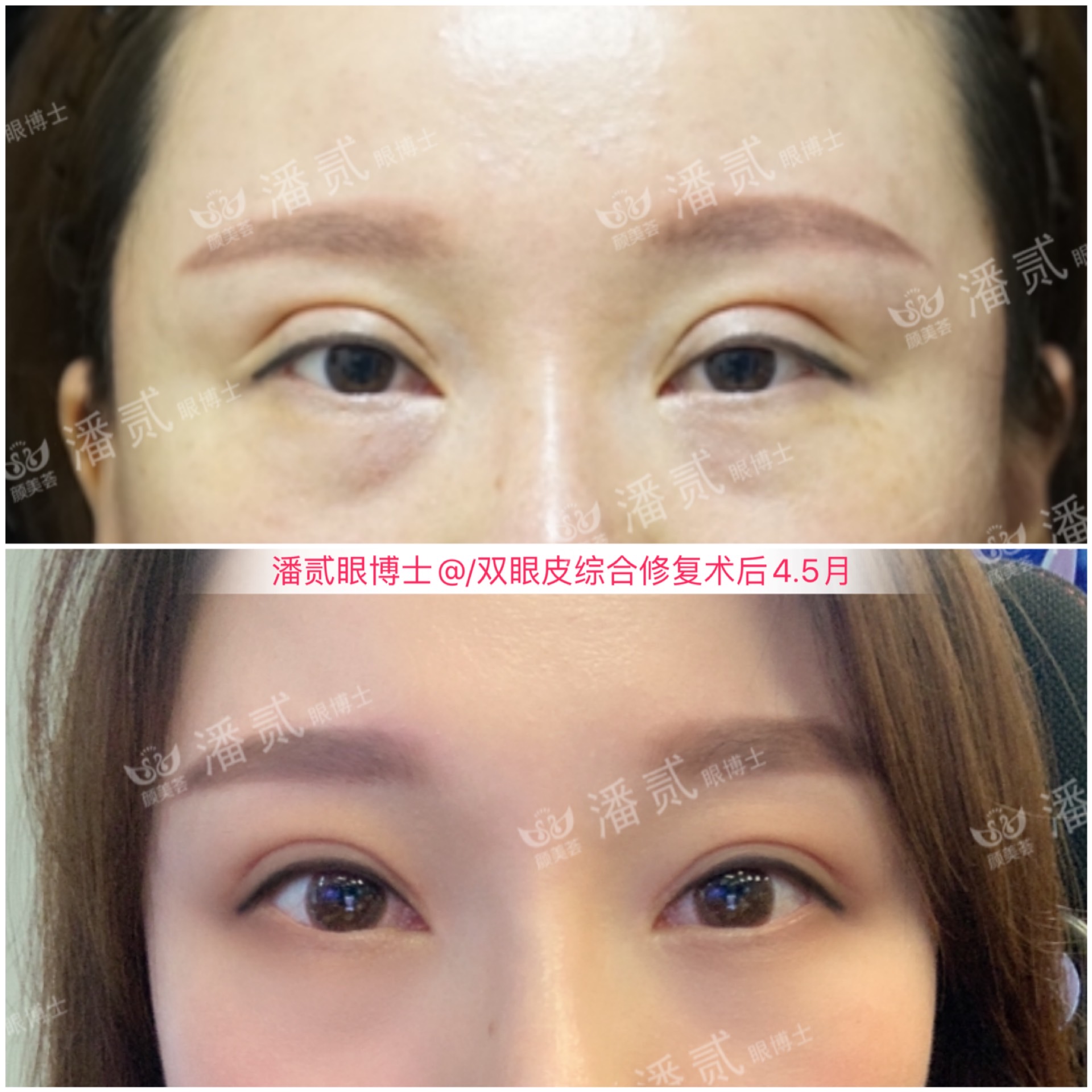 整容失败大眼女,整容12次失败之后长什么样