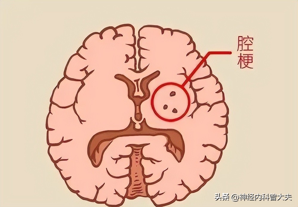 左侧岛叶区腔隙性脑梗死的症状,什么是腔隙性脑梗会引起什么症状