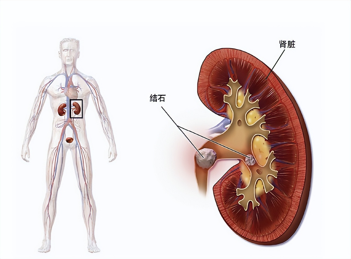 儿童有肾结石,儿童多发性肾结石