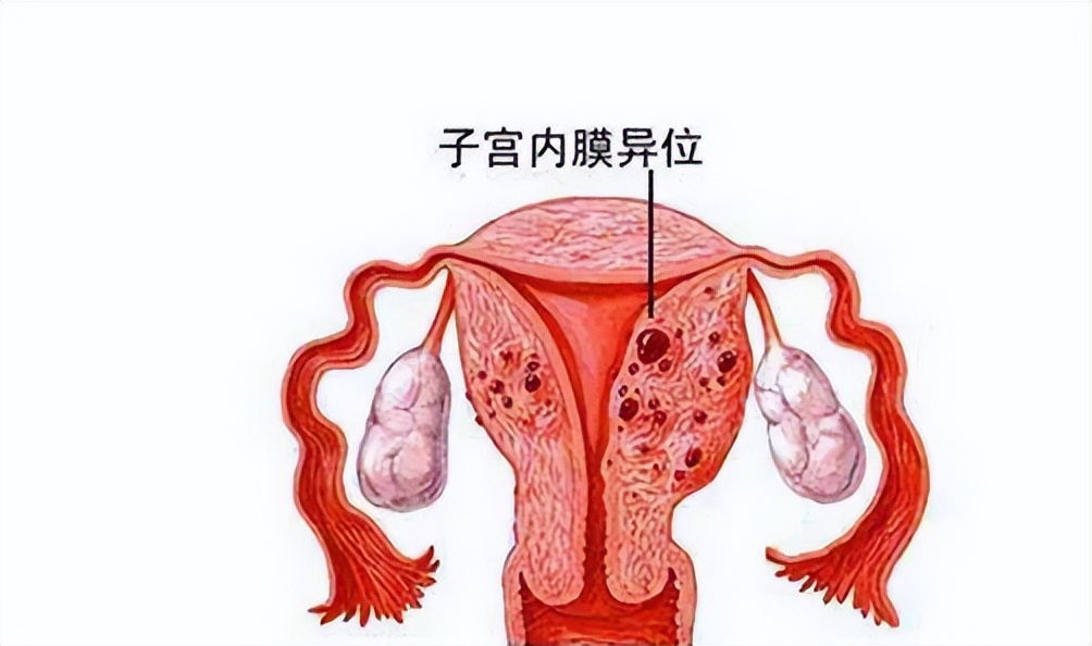 这几类人容易患子宫肌瘤,为什么会得子宫内膜异位症