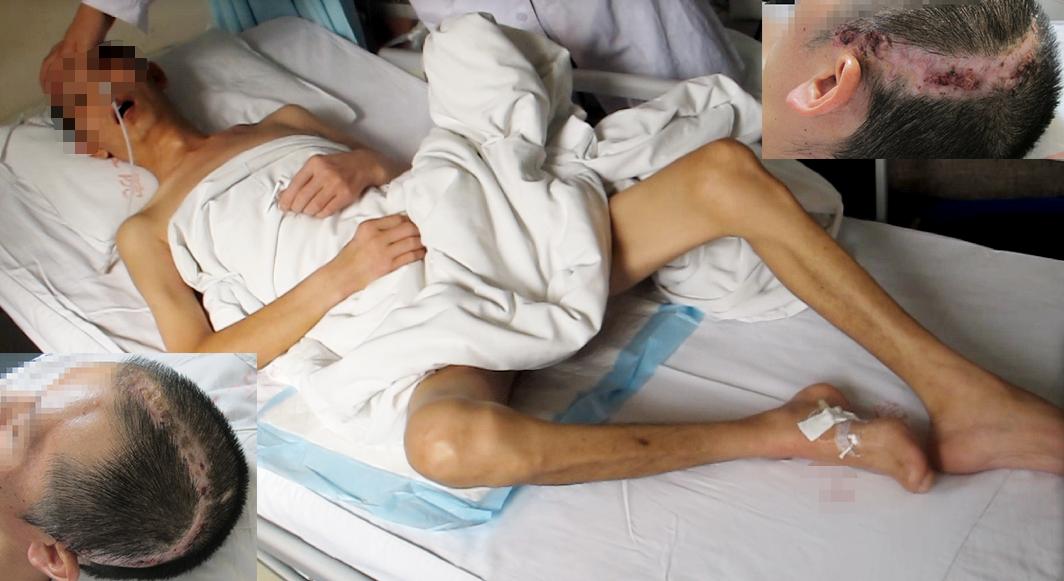 脑外伤开颅手术后继发癫痫,开颅术后颅内感染