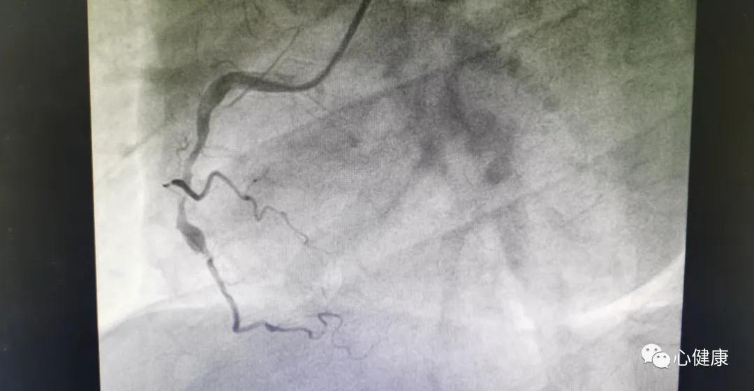 41岁心梗前兆,41岁死于心梗