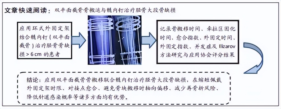 双平面截骨骨搬运联合髓内钉治疗胫骨大段骨缺损