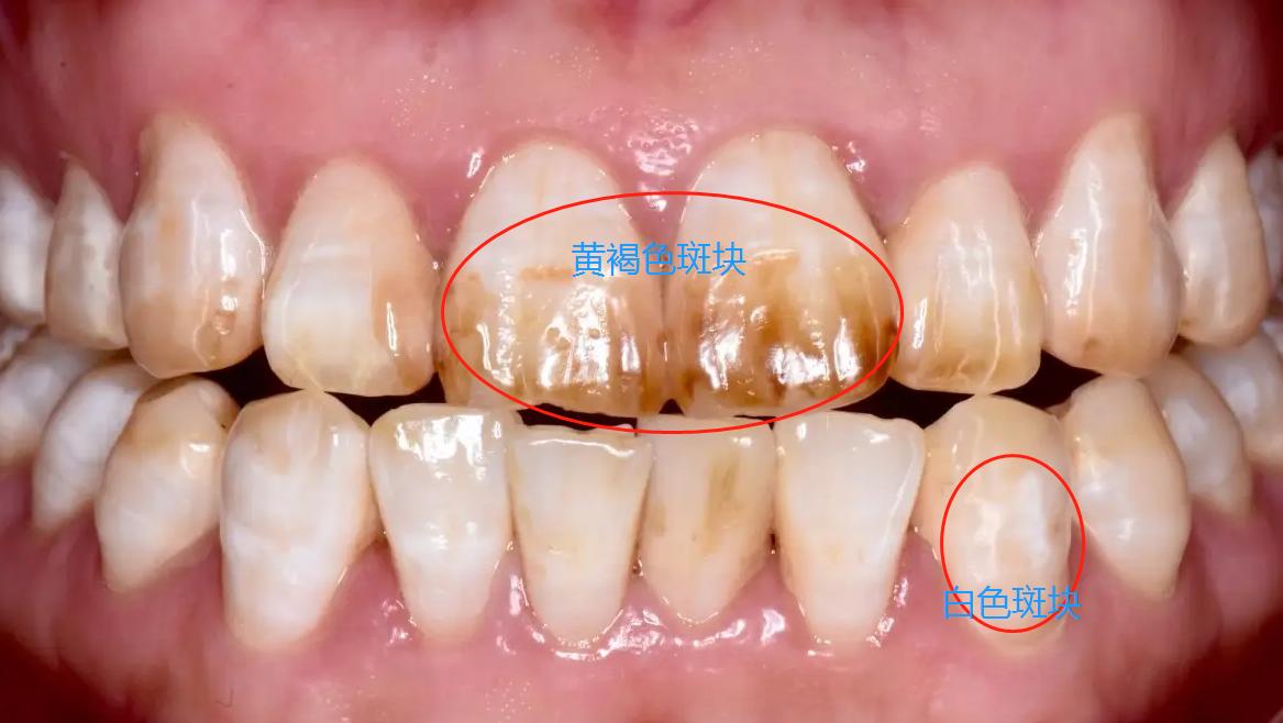 一分钟治愈牙齿黄斑,牙齿有病变怎么办