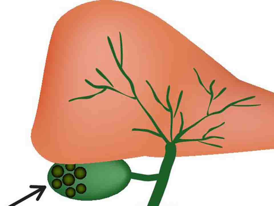 有了胆囊息肉还能吃黄体酮吗,胆囊息肉最快的自愈方法