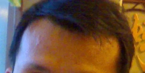 植发的亲身经历和感受,植发1000毛囊真实经历视频