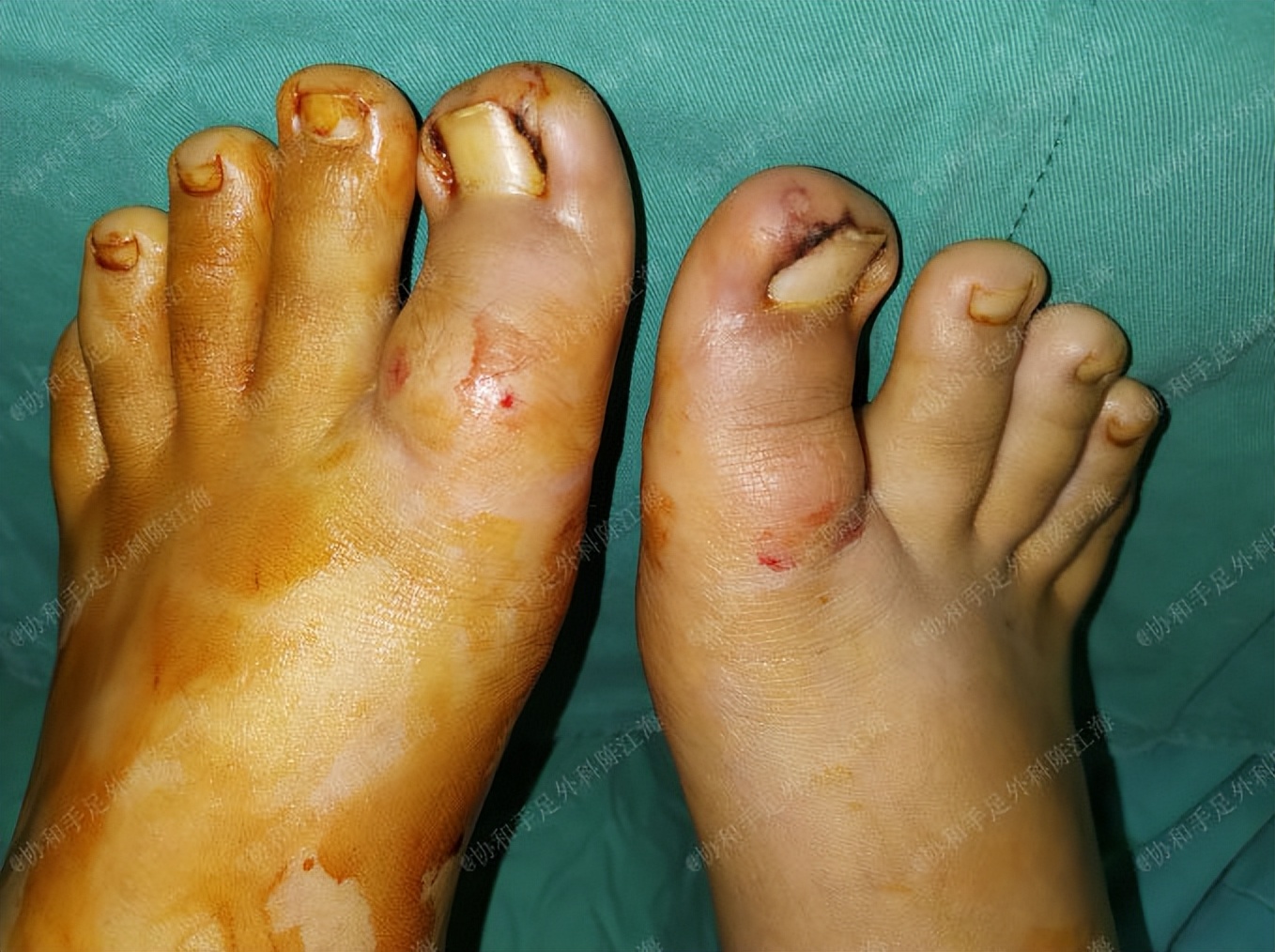 嵌甲怎么治疗才能彻底除根,嵌甲使用什么方法可以彻底根治