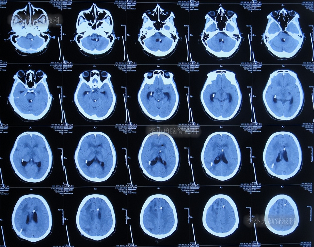 脑积水三脑室造瘘多久能恢复,脑囊虫手术后脑积水