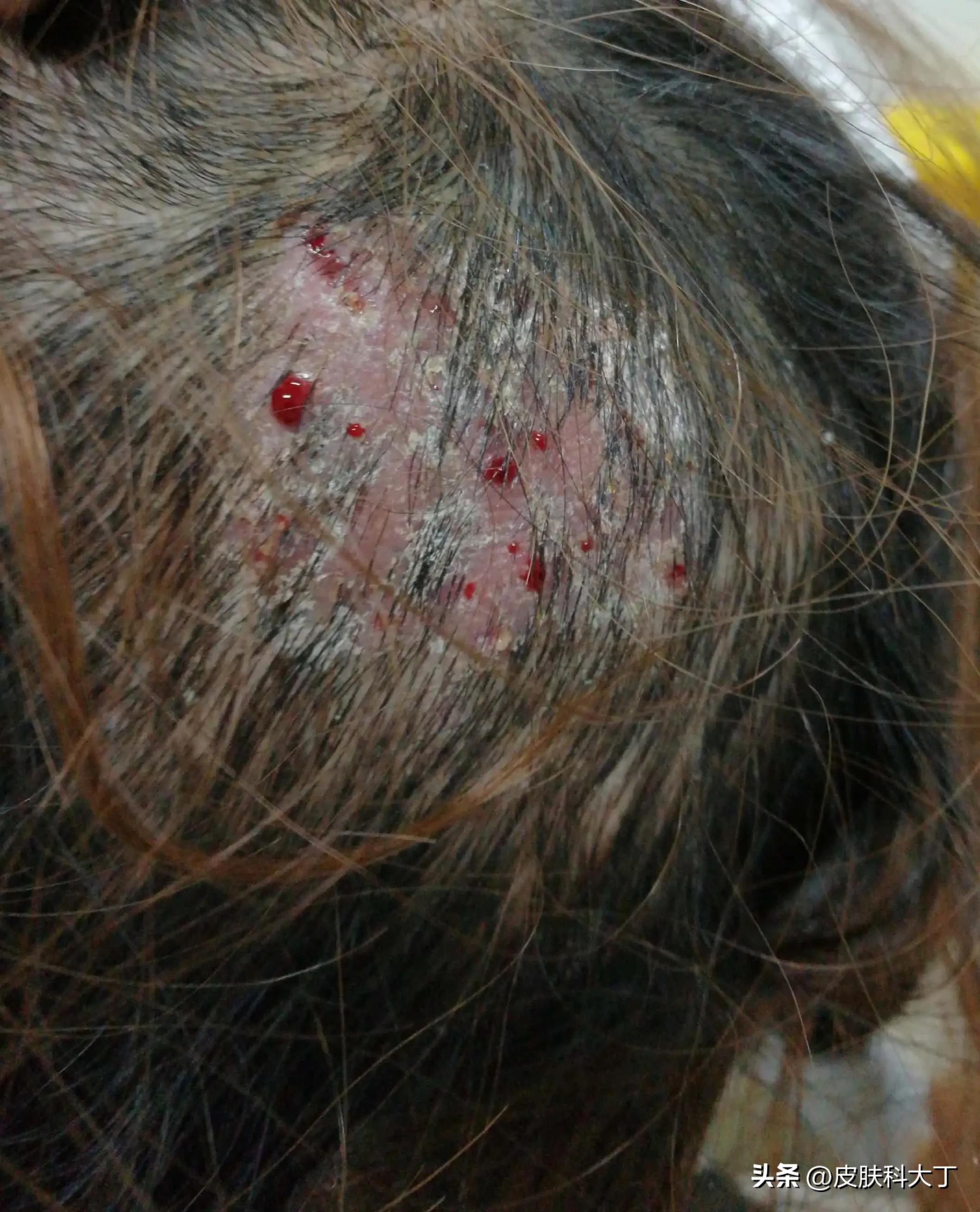 宠物狗容易导致小孩患头癣,因养狗得了癣怎么治