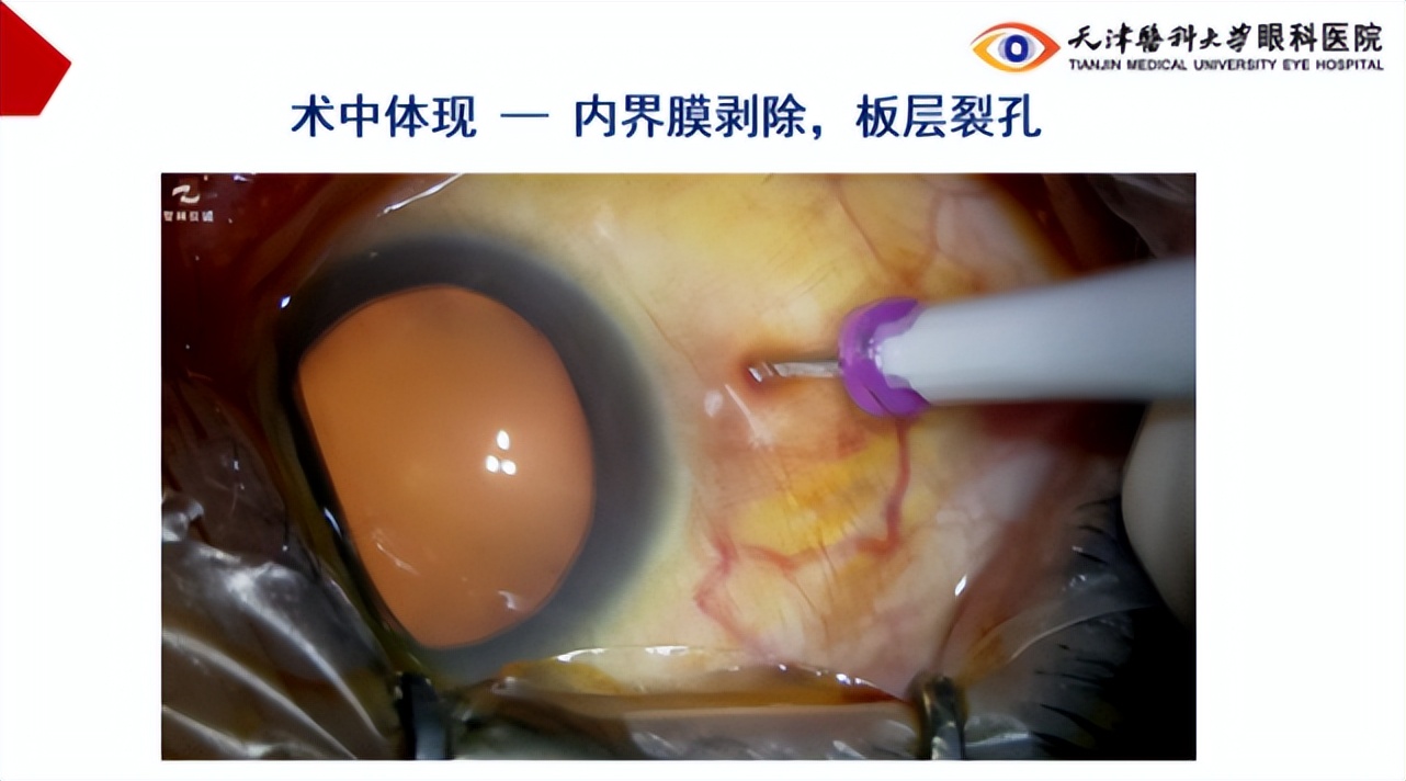 李筱荣教授,天津医科大学眼科医院李筱荣