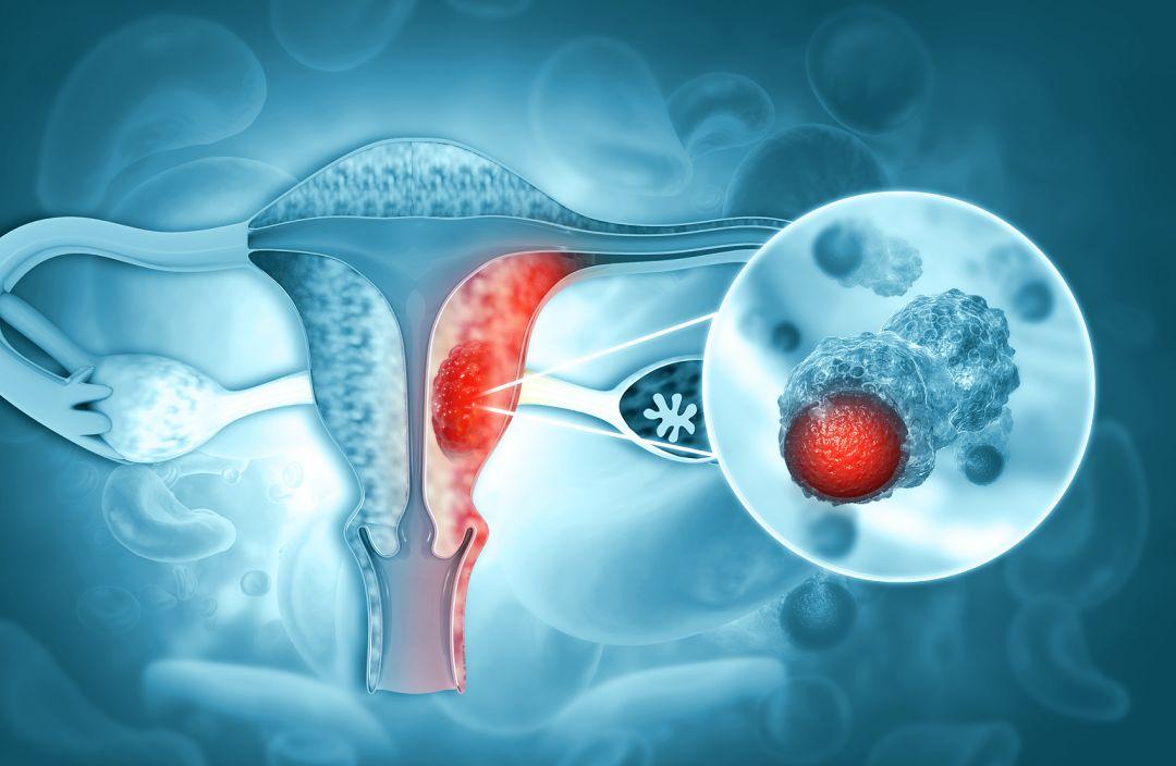 宫颈病变不除外高级病变,宫颈病变严重时肚子疼吗