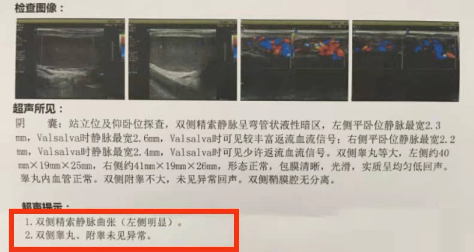 精索静脉曲张导致男性不育的比例,男性不育是精索静脉曲张引起的吗