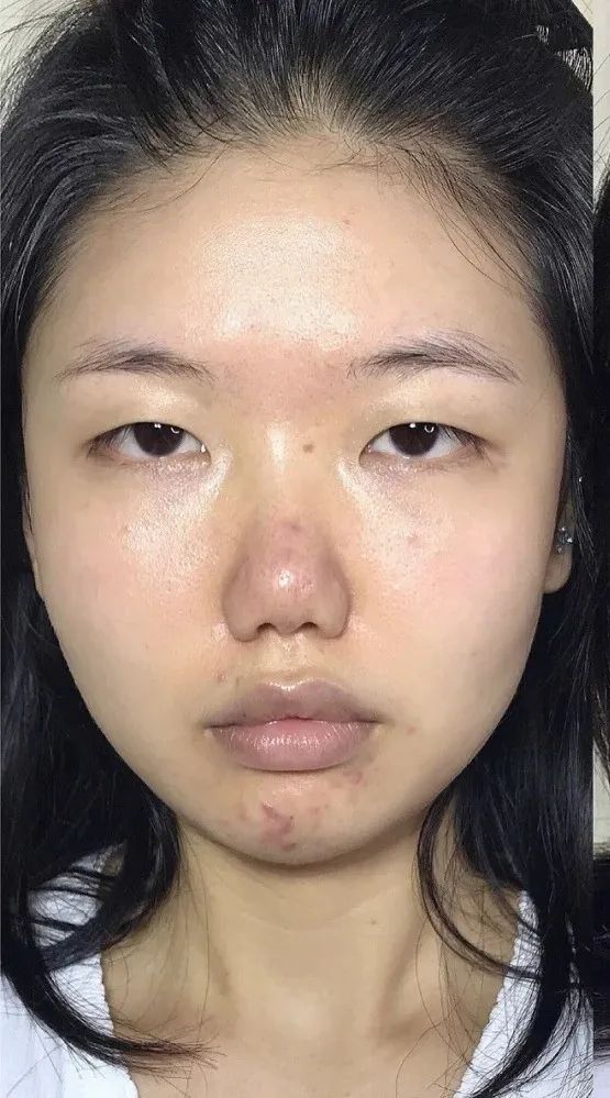 疲惫脸色不好怎么办,疲惫脸补救