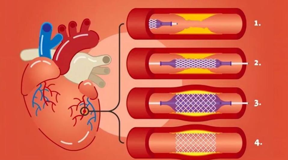 为什么吸烟能引起心梗呢,吸烟为什么会导致心梗