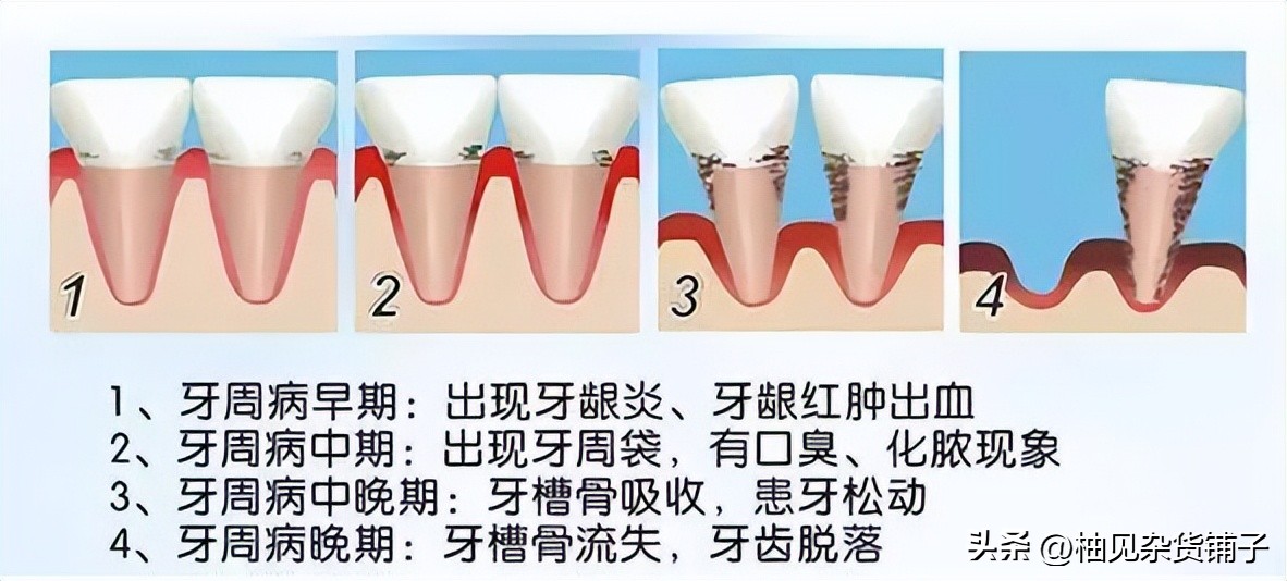 电动牙刷需要来回刷吗视频教学,关于电动牙刷