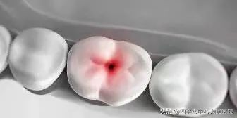 怎样防护龋齿,龋齿防护