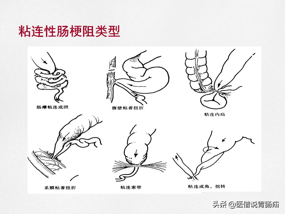 肠梗阻健康教育,肠梗阻患者的健康宣教