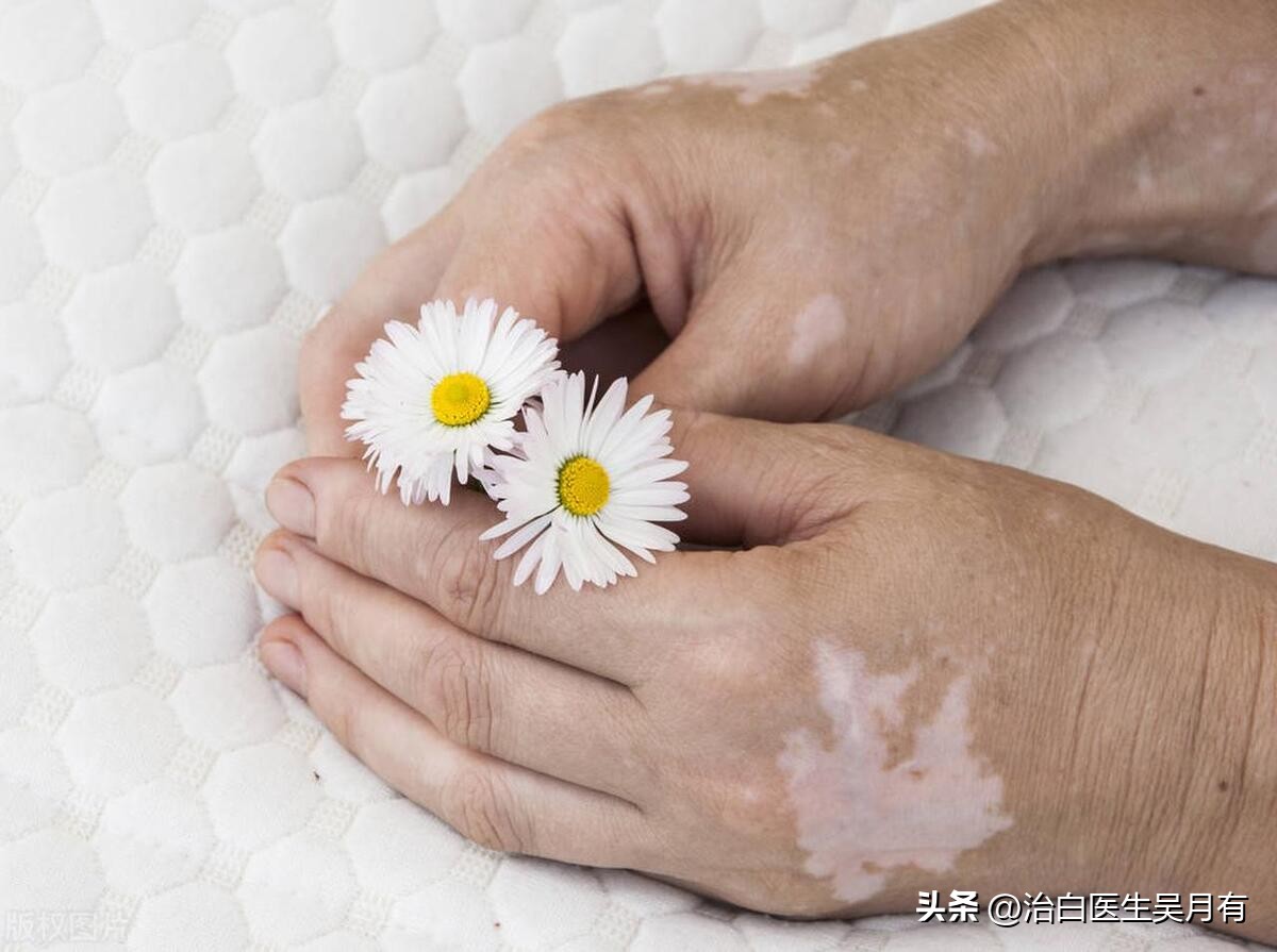 白癜风防治的几大原则,白癜风的小妙招