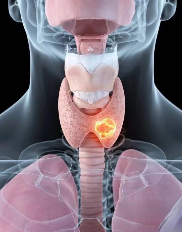 甲状腺手术以后你们胖了吗,甲状腺术后遇上大姨妈