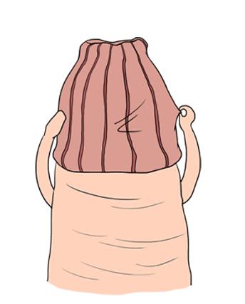 包皮术后感染有硬块吗,包皮术后感染怎么办