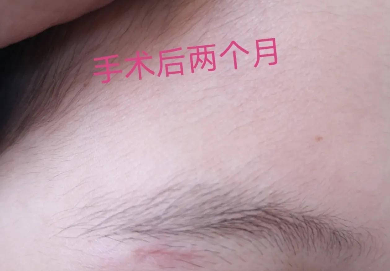 皮脂腺囊肿和粉刺瘤,火针治疗皮脂腺囊肿