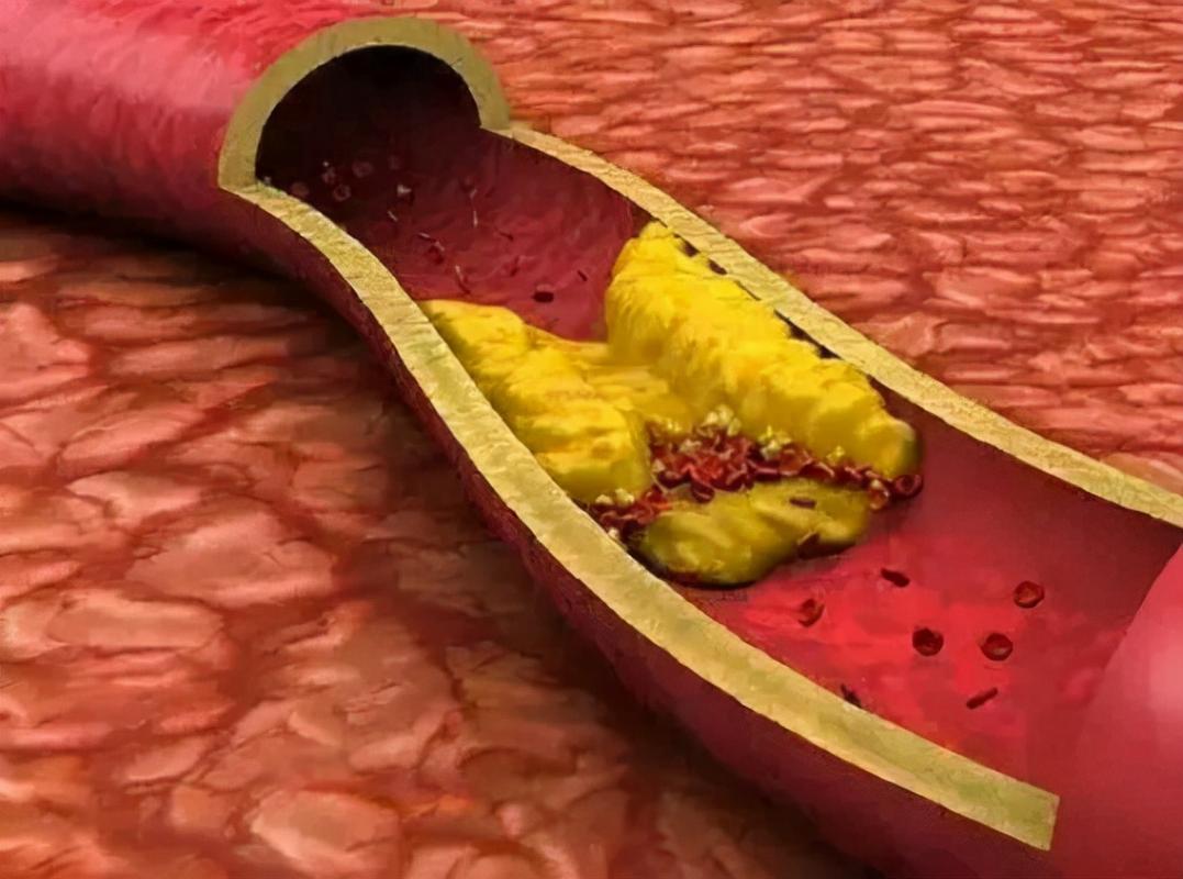 服用他汀和阿司匹林的禁忌是什么,医生长期服用他汀的后果