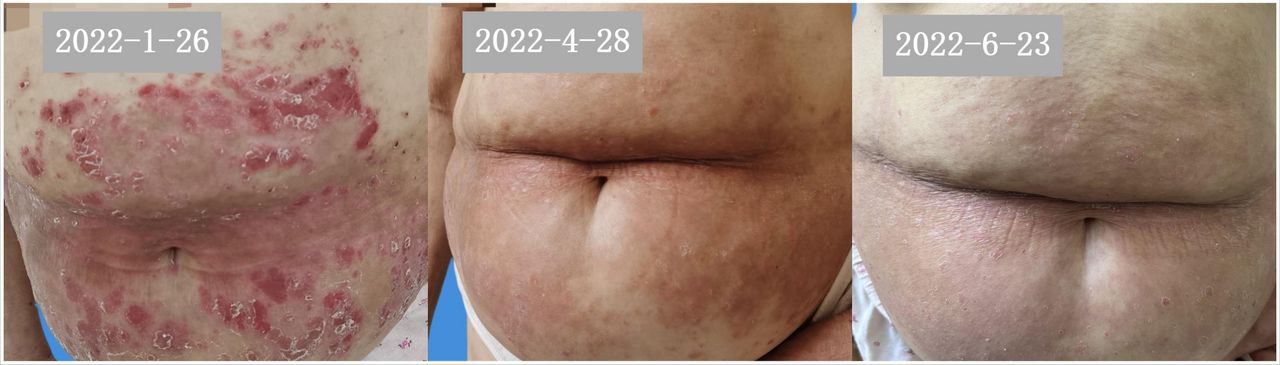 白介素23抑制剂治疗斑块状银屑病,治疗斑块型银屑病最好的方法