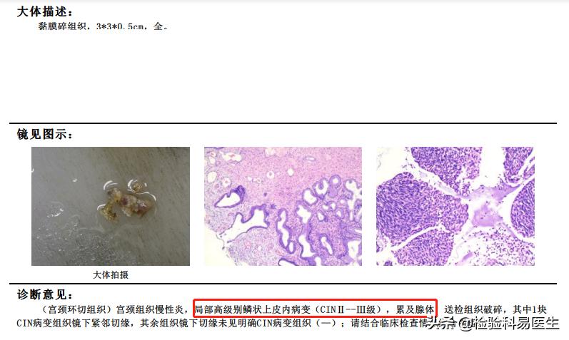 女性宫颈病变怎么引起的,hpv阴性为什么会宫颈高度病变