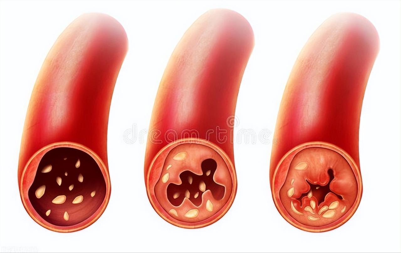 2药补气活血、化瘀开窍，降脂溶栓疏通冠脉，养心护脑兼改善抑郁