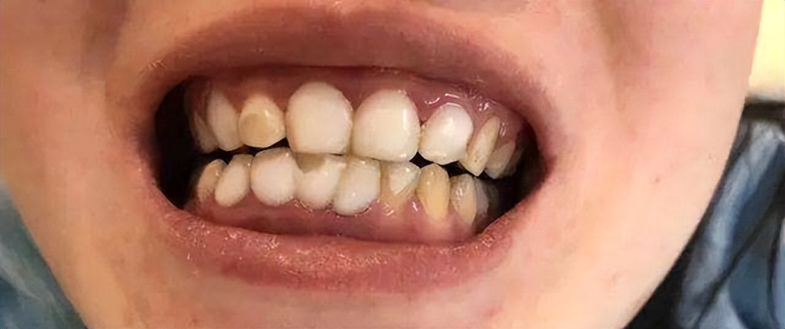 口腔护理牙齿步骤,牙科小常识牙齿敏感