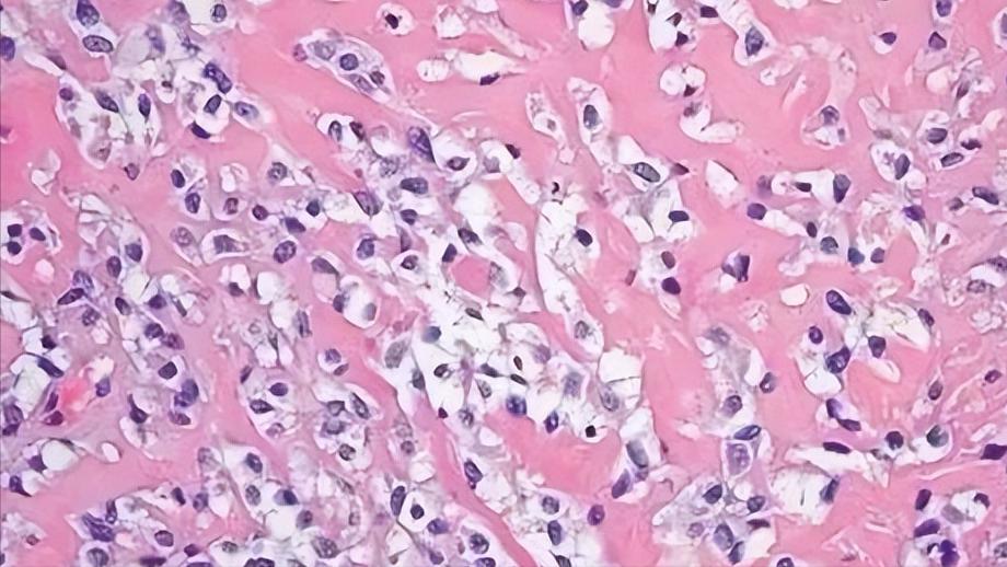 罕见恶性肿瘤肉瘤科普,软组织恶性肉瘤是癌症吗