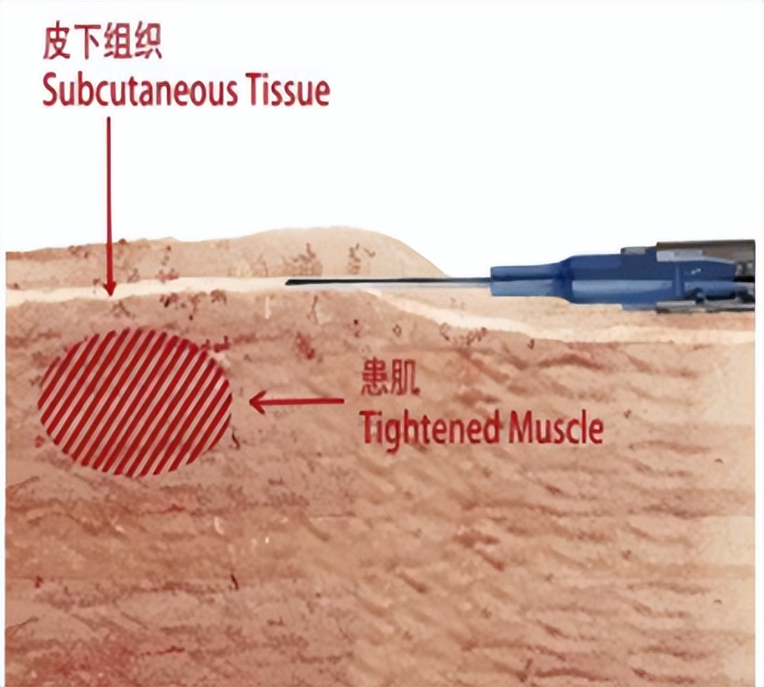崴脚、富贵包、腰痛这些都可以去一个科一针搞定