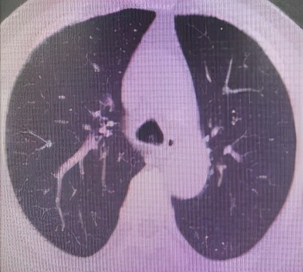 哈医大一院气管镜,哈医大群力呼吸内科