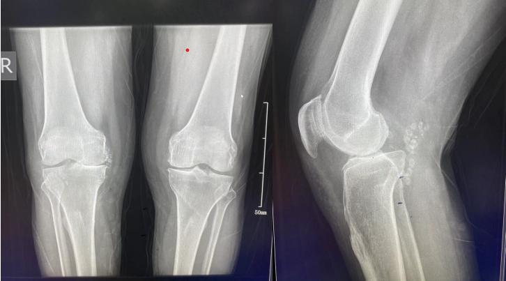 膝关节置换可以根治关节炎吗,关节炎只有膝关节置换一条路吗