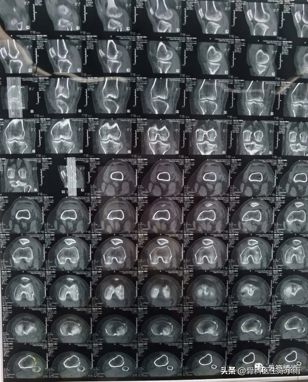 膝关节胫骨平台骨折,最近胫骨平台骨折视频