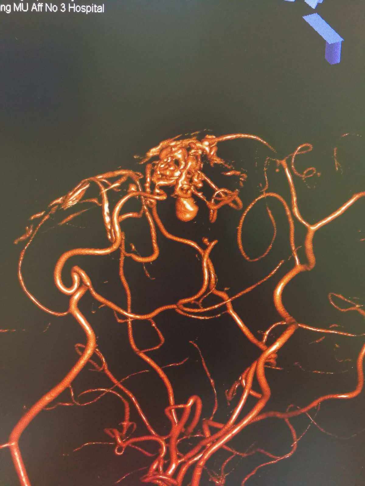 动脉瘤蛛网膜下腔出血术后并发症,动脉瘤导致蛛网膜下腔出血严重吗