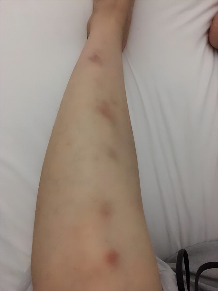 紫癜最忌口食物一览表,紫癜初期小血点图片