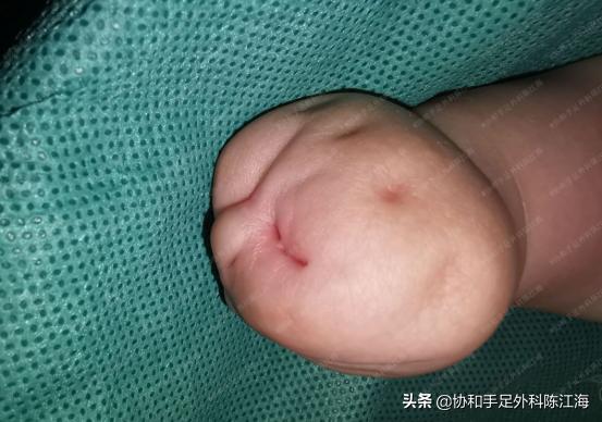 束带综合征手术多大可以做,束带综合征动手术后期有影响吗