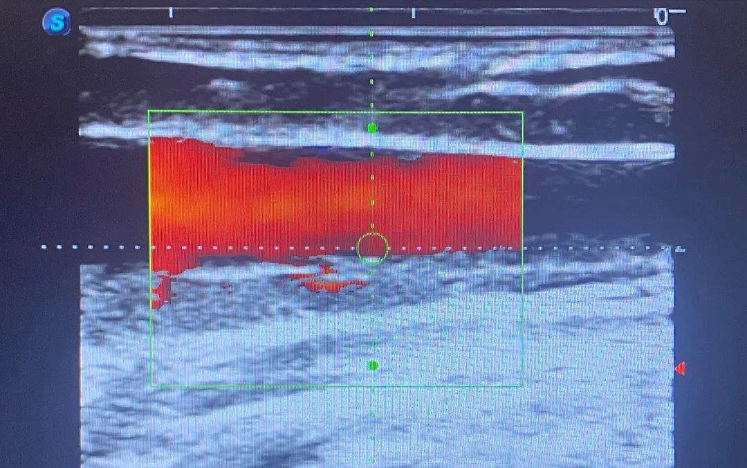 血管造瘘透析,血管人工搭桥