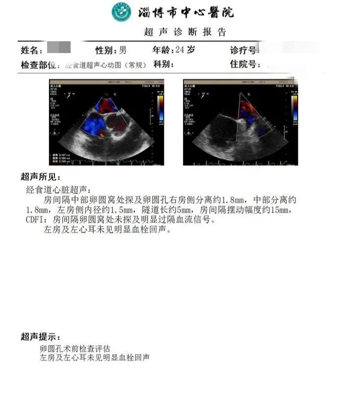中国卵圆孔未闭封堵手术第一例,哈医大卵圆孔未闭介入封堵术