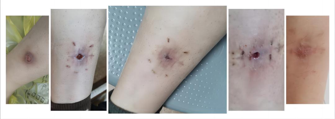 济南市莱芜人民医院:伤口难以愈合高压氧治疗悄悄抚平您的伤口