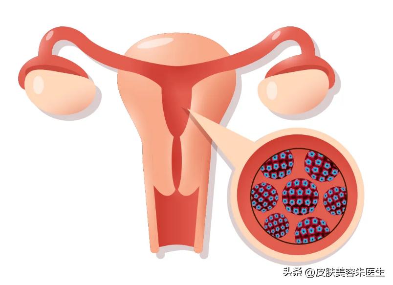 怎么区分尖锐性湿疣和生殖器疱疹,分辨尖锐性湿疣