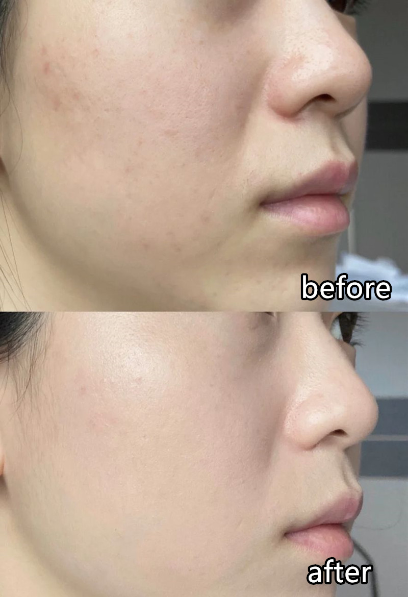 挤黑头用什么收缩或张开毛孔,挤黑头后毛孔大怎么物理修复