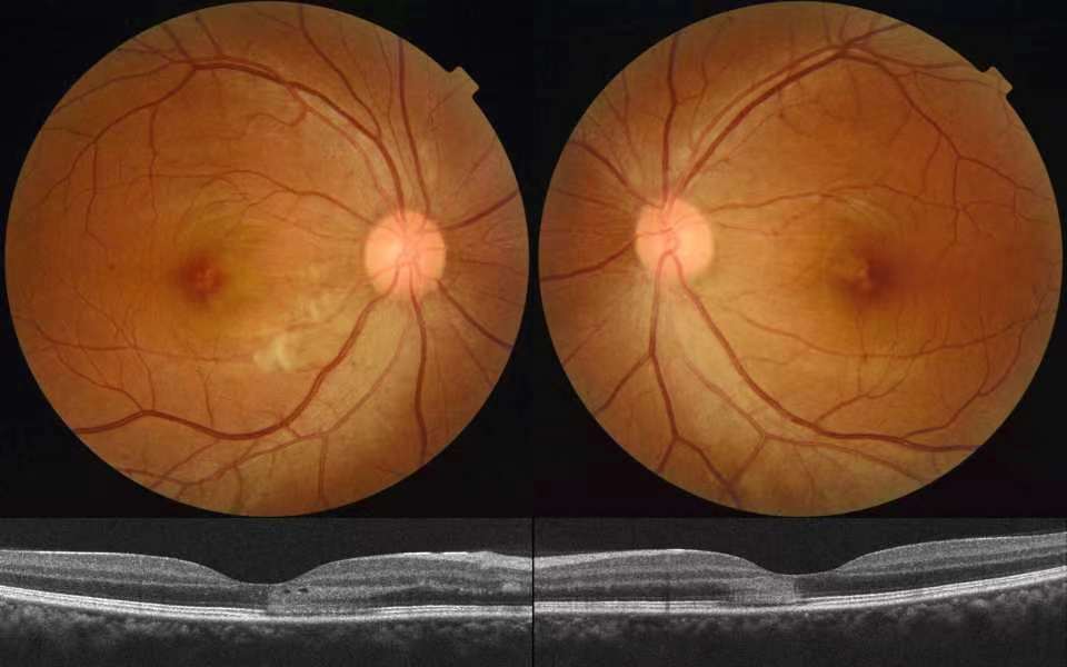 阳过之后间歇性失明,这三种眼病要当心失明