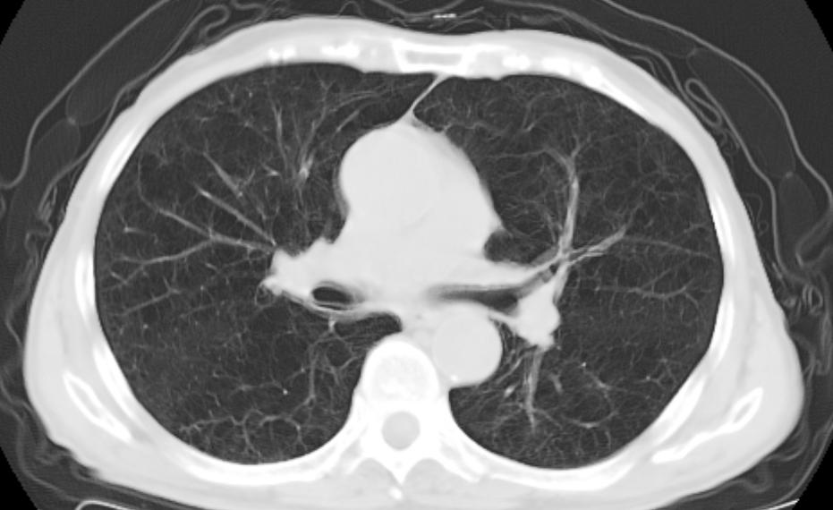 80岁慢阻肺喘的厉害怎么治疗,年青人患了重度慢阻肺能治好吗